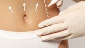 Liposuccion associée à une abdominoplastie 